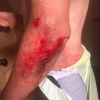 Ben Dixon's road rash